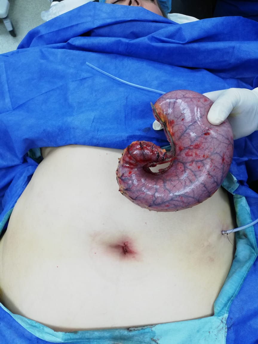 gastric bypass revisions
